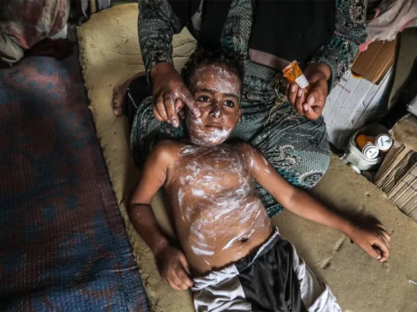 فلسطینی بچوں میں چکن پاکس کے کیسز میں مسلسل اضافہ